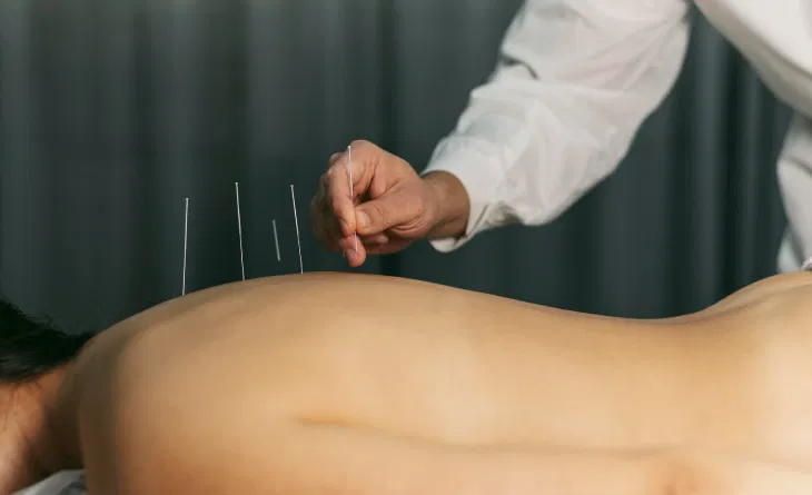 Sessão de acupuntura